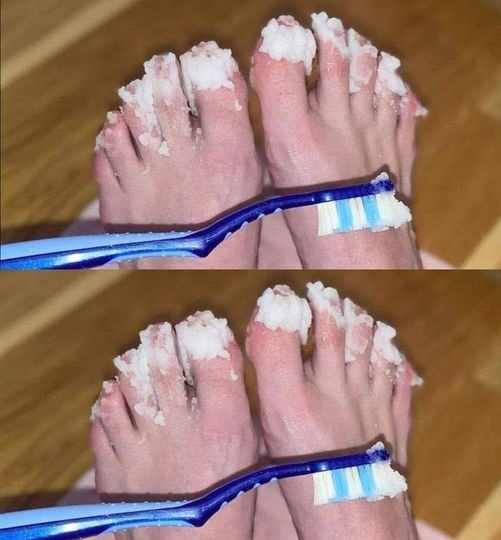 If you have nail fungus try this natural remedy: it disappears quickly