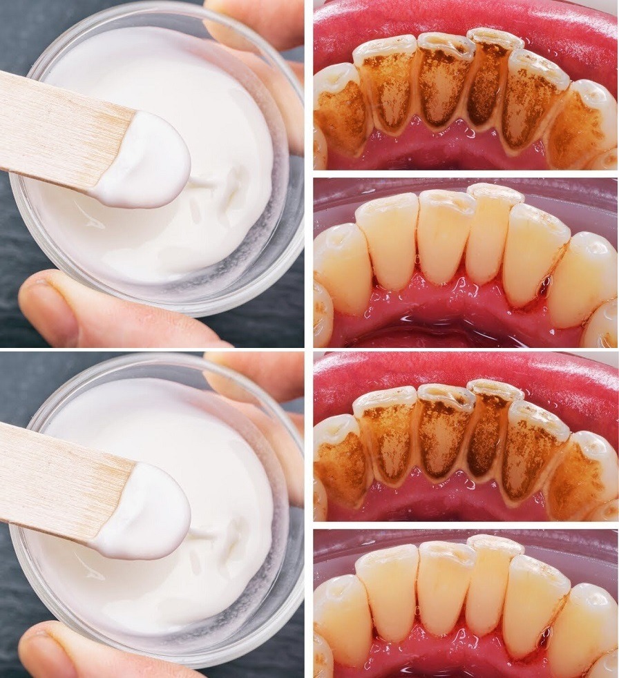 Discovering Baking Soda’s Potential for a Better Mouth and Teeth